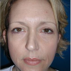 Rhinoplasty Before & After Patient #5848