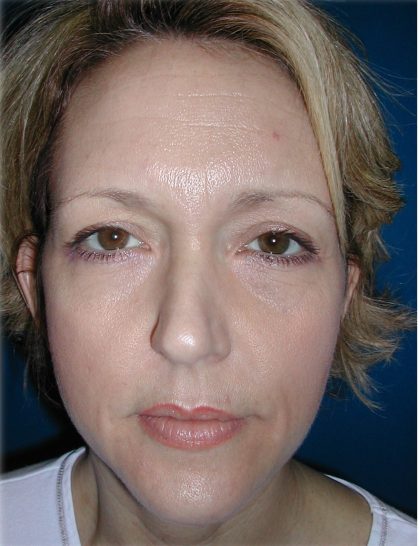 Rhinoplasty Before & After Patient #5848