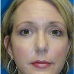 Rhinoplasty Before & After Patient #5848