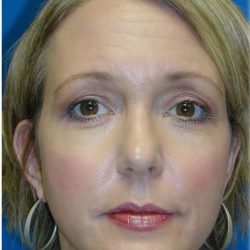 Rhinoplasty Before & After Patient #5848