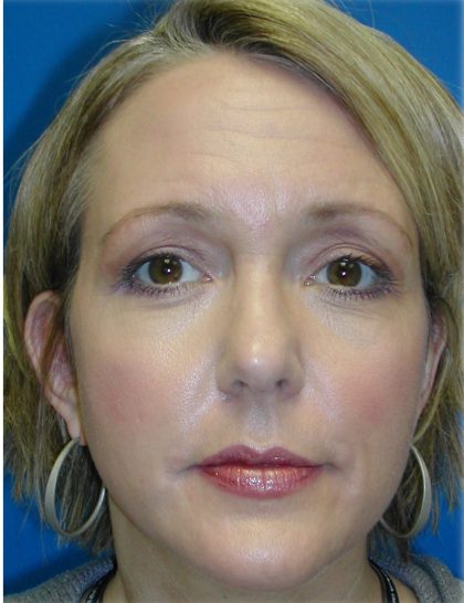 Rhinoplasty Before & After Patient #5848