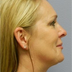 Chin Augmentation Before & After Patient #6720