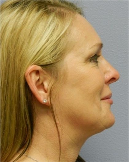 Chin Augmentation Before & After Patient #6720