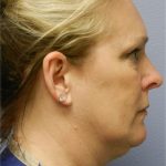 Chin Augmentation Before & After Patient #6720
