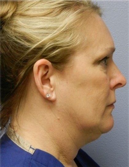 Chin Augmentation Before & After Patient #6720