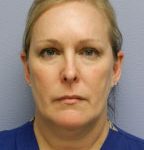 Facial Liposuction Before & After Patient #6754