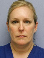 Facial Liposuction Before & After Patient #6754