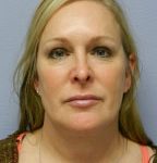 Facial Liposuction Before & After Patient #6754