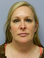 Facial Liposuction Before & After Patient #6754