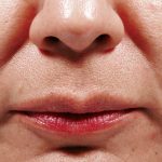 Bellafill Before & After Patient #6758