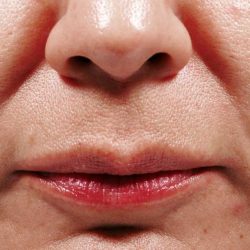 Bellafill Before & After Patient #6758