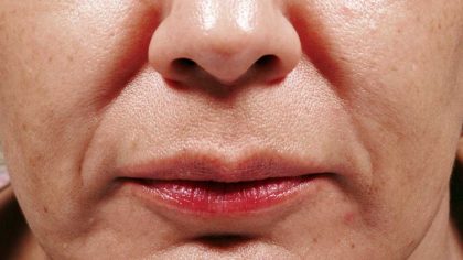 Bellafill Before & After Patient #6758