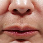 Bellafill Before & After Patient #6758