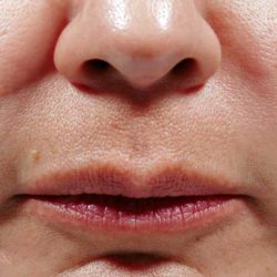 Bellafill Before & After Patient #6758