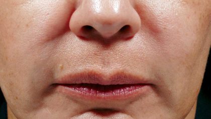 Bellafill Before & After Patient #6758