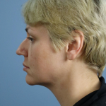 Deep Plane Facelift Before & After Patient #7744