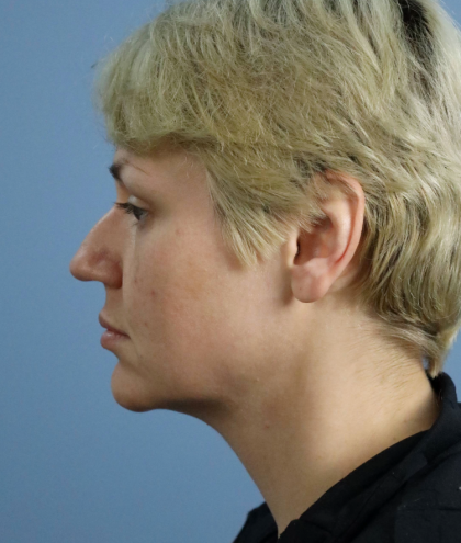 Deep Plane Facelift Before & After Patient #7744