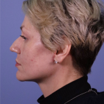 Deep Plane Facelift Before & After Patient #7744