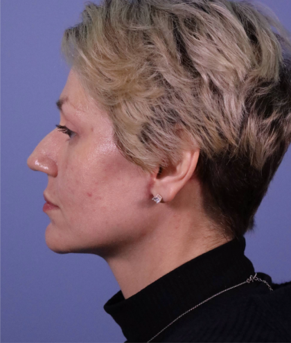 Deep Plane Facelift Before & After Patient #7744