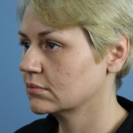 Deep Plane Facelift Before & After Patient #7744