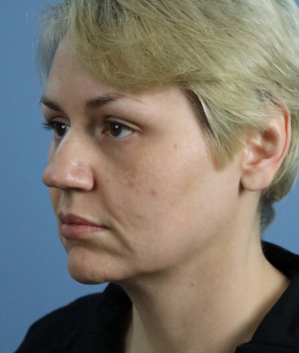 Deep Plane Facelift Before & After Patient #7744