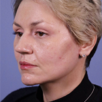 Deep Plane Facelift Before & After Patient #7744