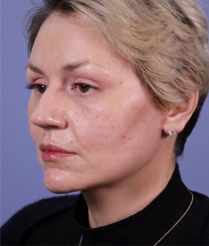 Deep Plane Facelift Before & After Patient #7744
