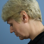 Deep Plane Facelift Before & After Patient #7744