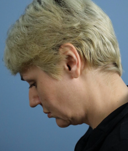 Deep Plane Facelift Before & After Patient #7744