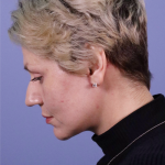 Deep Plane Facelift Before & After Patient #7744