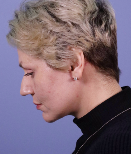 Deep Plane Facelift Before & After Patient #7744