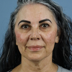 Deep Plane Facelift Before & After Patient #7745