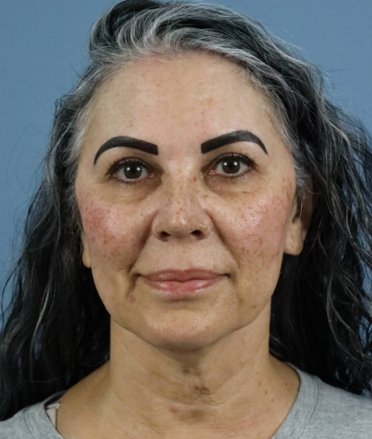 Deep Plane Facelift Before & After Patient #7745