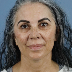 Deep Plane Facelift Before & After Patient #7745