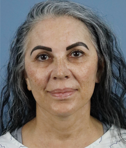 Deep Plane Facelift Before & After Patient #7745