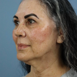 Deep Plane Facelift Before & After Patient #7745