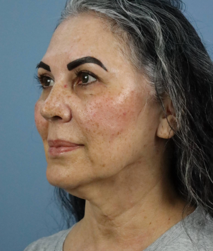 Deep Plane Facelift Before & After Patient #7745