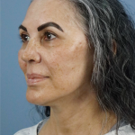 Deep Plane Facelift Before & After Patient #7745