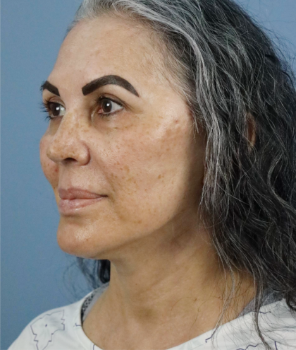 Deep Plane Facelift Before & After Patient #7745